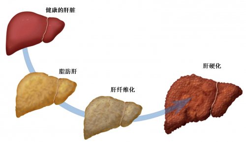 脂肪肝偏方